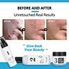 Acne Treatment Skin Care Set